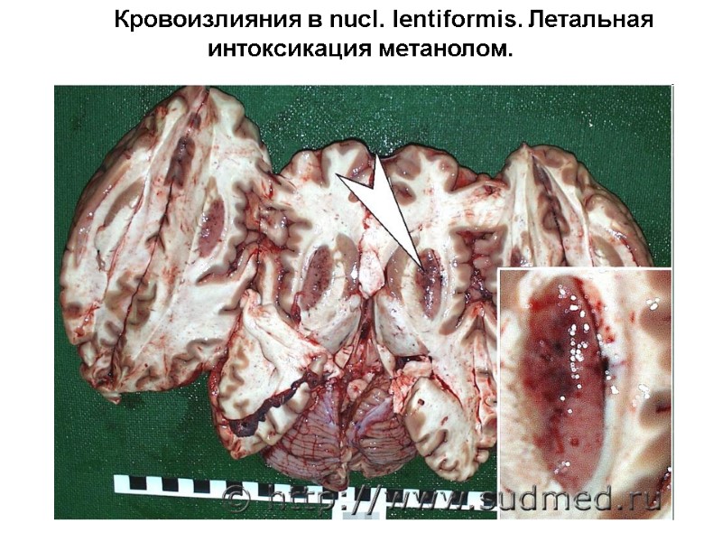 Кровоизлияния в nucl. lentiformis. Летальная интоксикация метанолом.